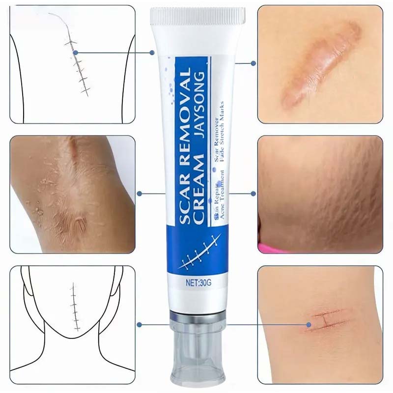 Professional Scar Removal Gel-Multi-Type Scar Carel For Keloids