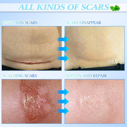 Skin Smoothing Scar Cream, Lighten & Repair All Scars🧴