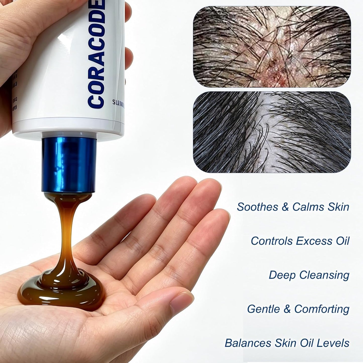 Folliculitis Shampoo for Itchy, Flaky Scalp - Purifying Formula for a Soothed
