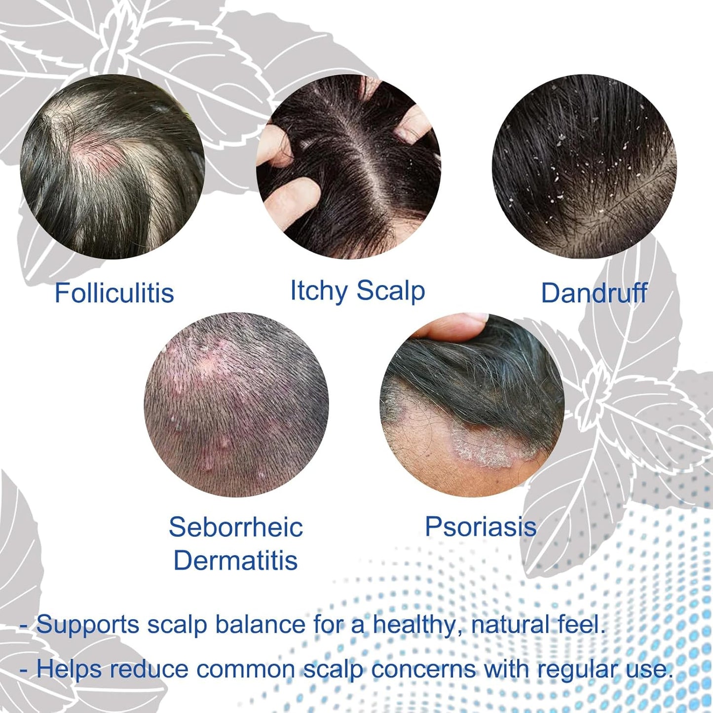 Folliculitis Shampoo for Itchy, Flaky Scalp - Purifying Formula for a Soothed