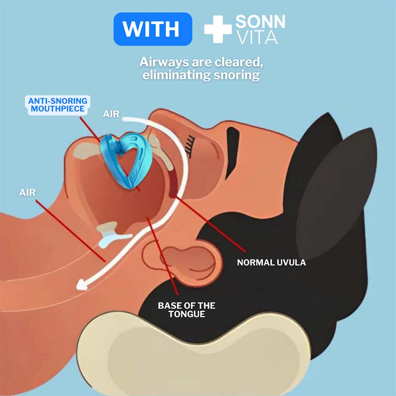 Comfortable Anti-Snoring Device, Nighttime Sleep Aid💤