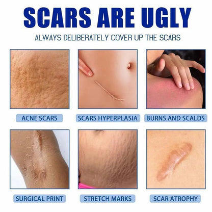 Professional Scar Removal Gel-Multi-Type Scar Carel For Keloids
